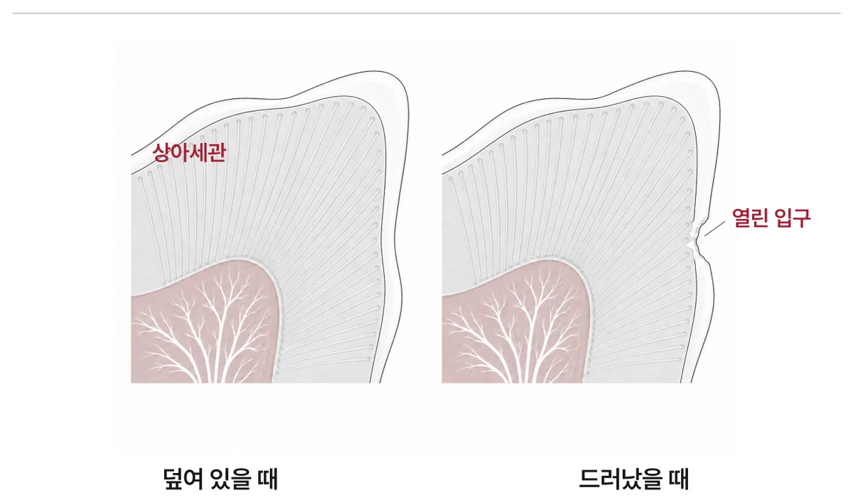 그림 2. 상아세관이 덮여 있을 때와 드러났을 때