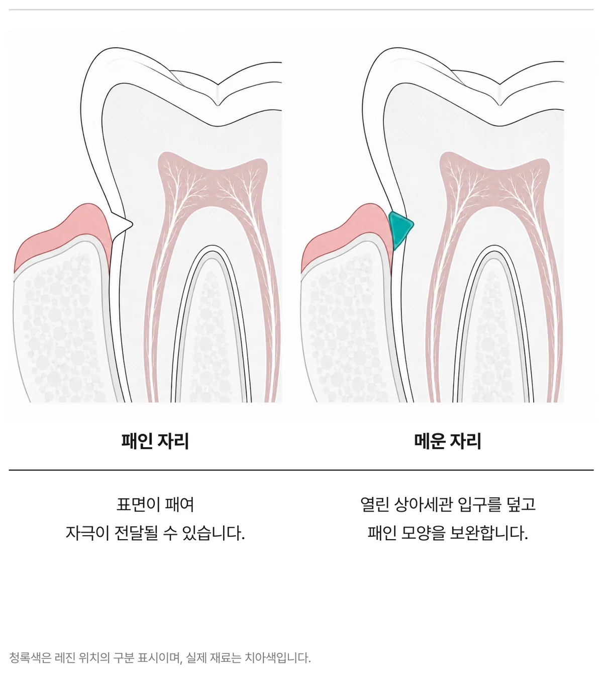 그림 6. 패인 자리와 레진으로 메운 자리