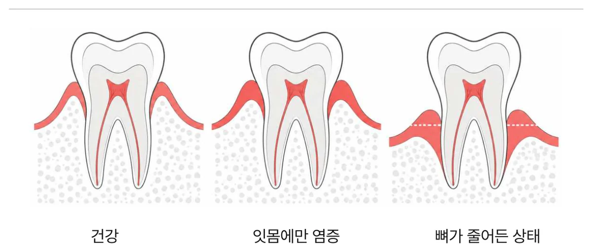그림 3. 염증이 잇몸 속으로 내려갈 때