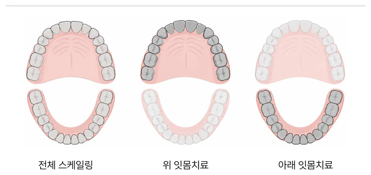 그림 6. 치료를 나누어 진행하는 순서