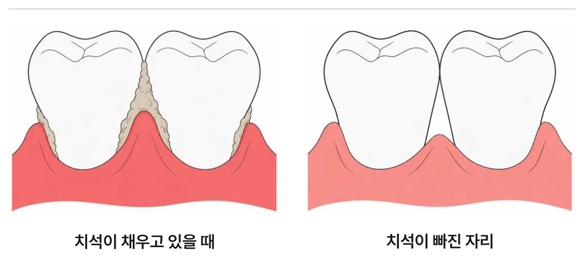 그림 7. 치석이 빠진 자리에 생기는 공간