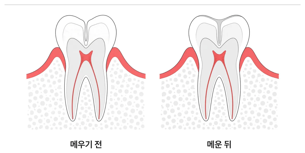그림 2. 홈을 메우기 전과 후