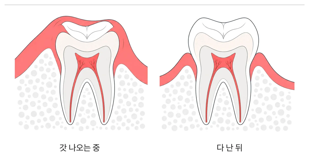 그림 5. 갓 난 어금니와 다 난 어금니
