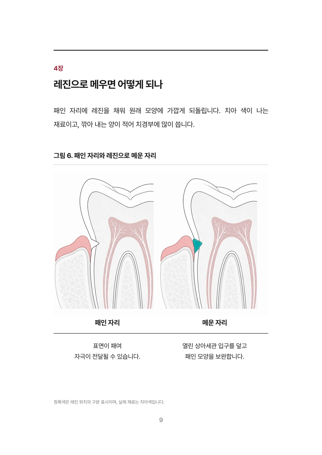 9면 4장 레진으로 메우면 어떻게 되나