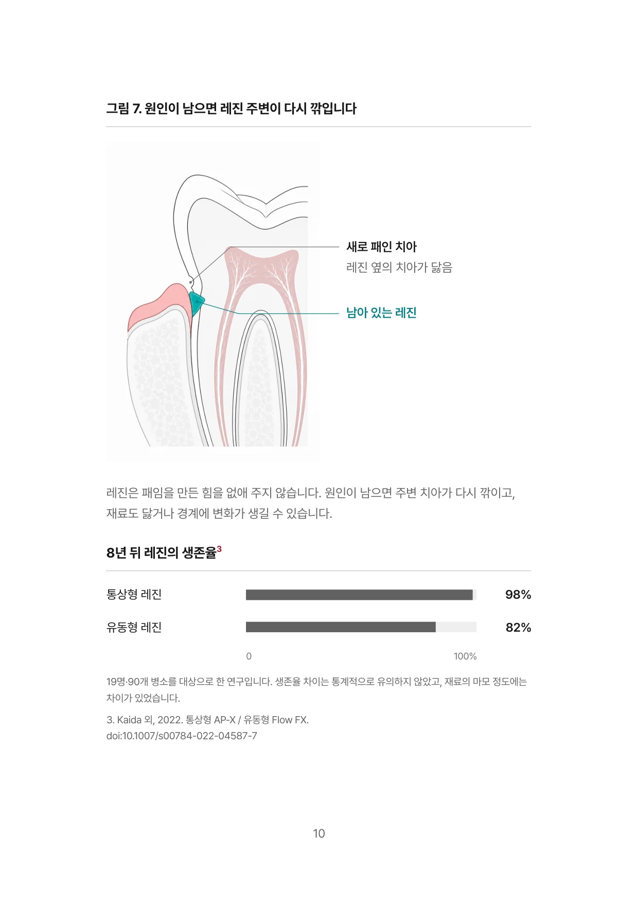 10면 원인이 남으면 레진 주변이 다시 깎입니다, 8년 뒤 레진의 생존율