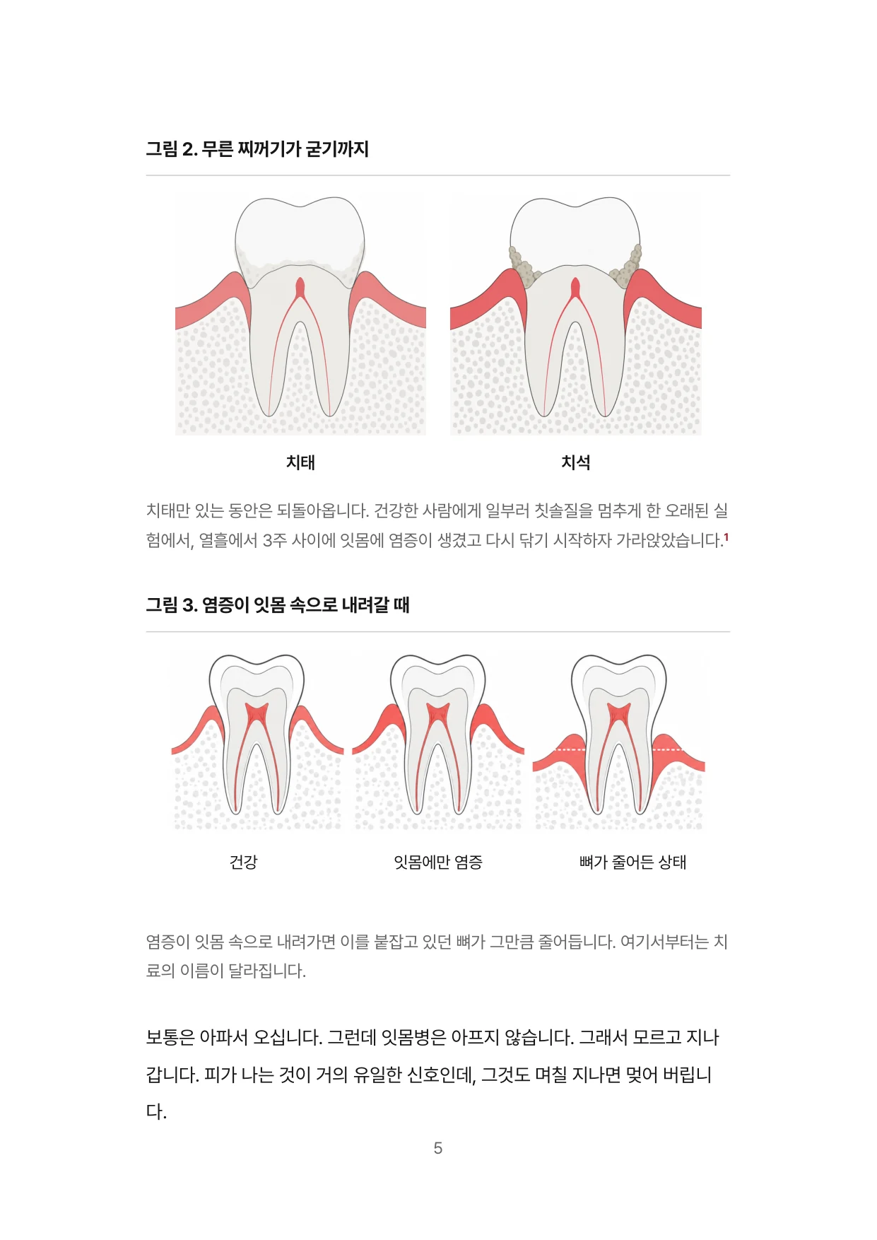 5면 무른 찌꺼기가 굳기까지, 염증이 잇몸 속으로 내려갈 때