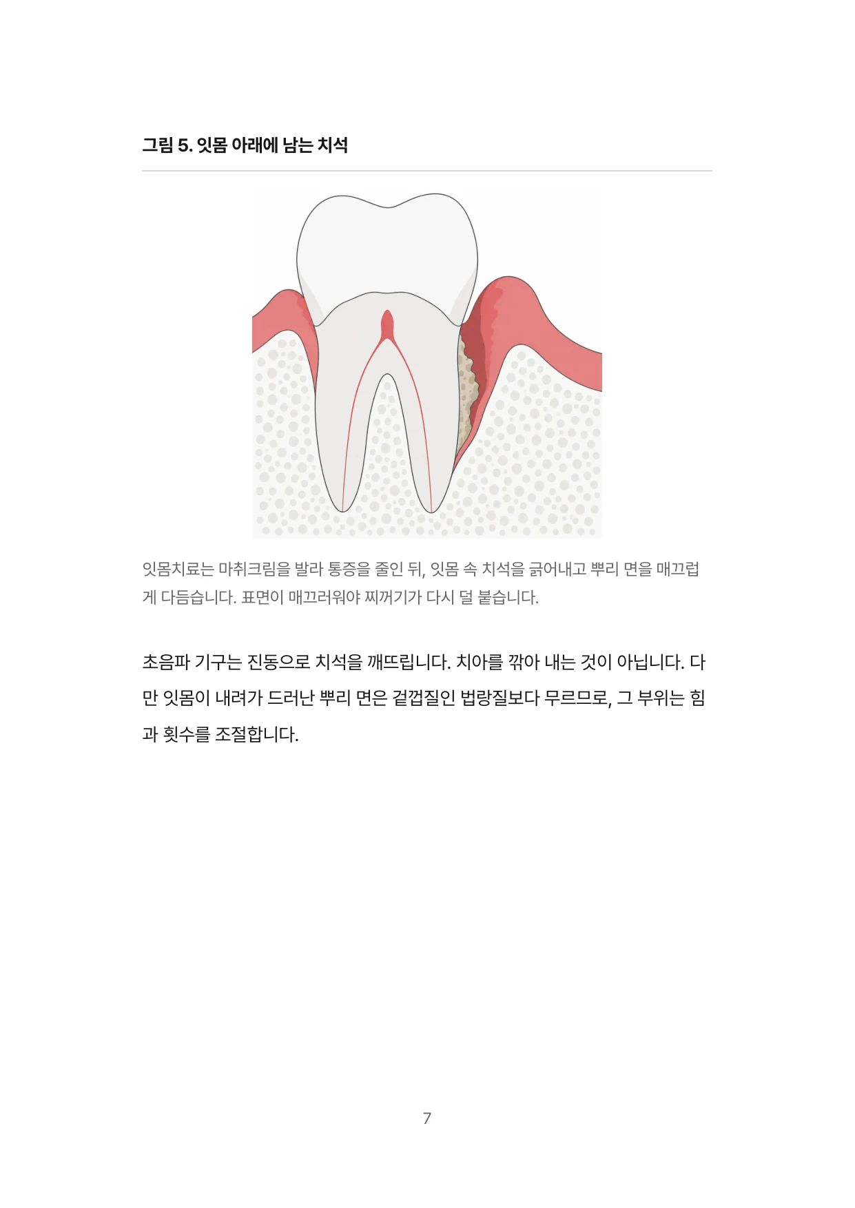 7면 잇몸 아래에 남는 치석
