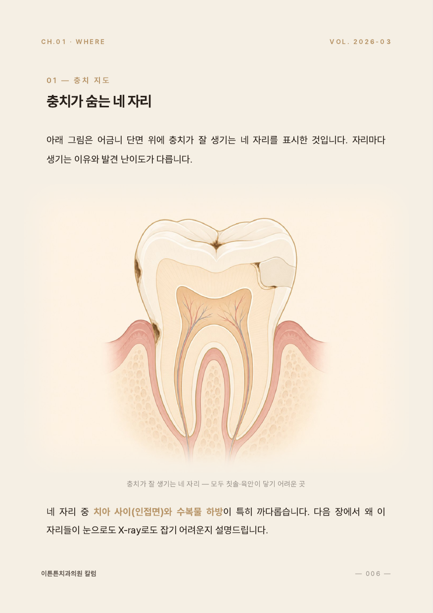 6면 충치가 잘 생기는 네 자리 인포그래픽