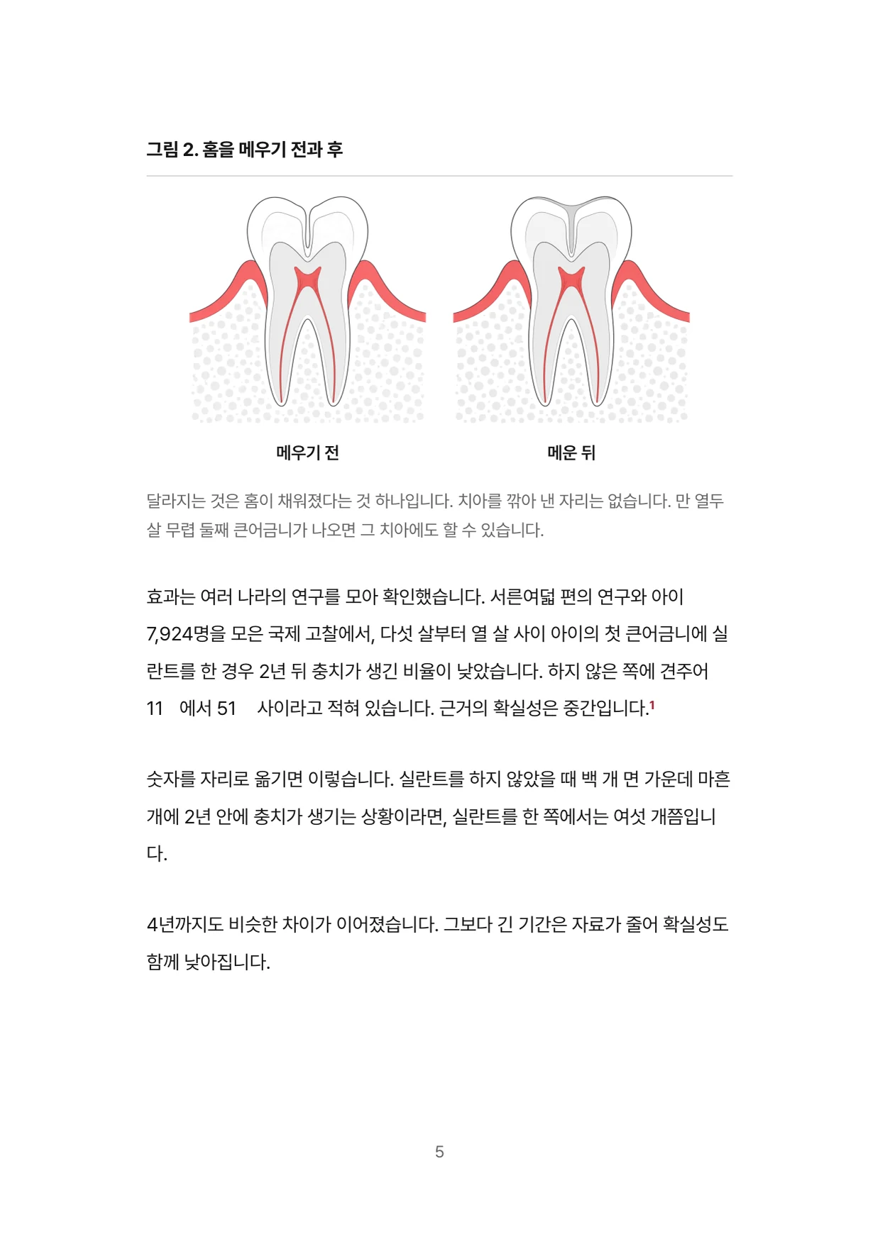 5면 홈을 메우기 전과 후, 실란트의 효과
