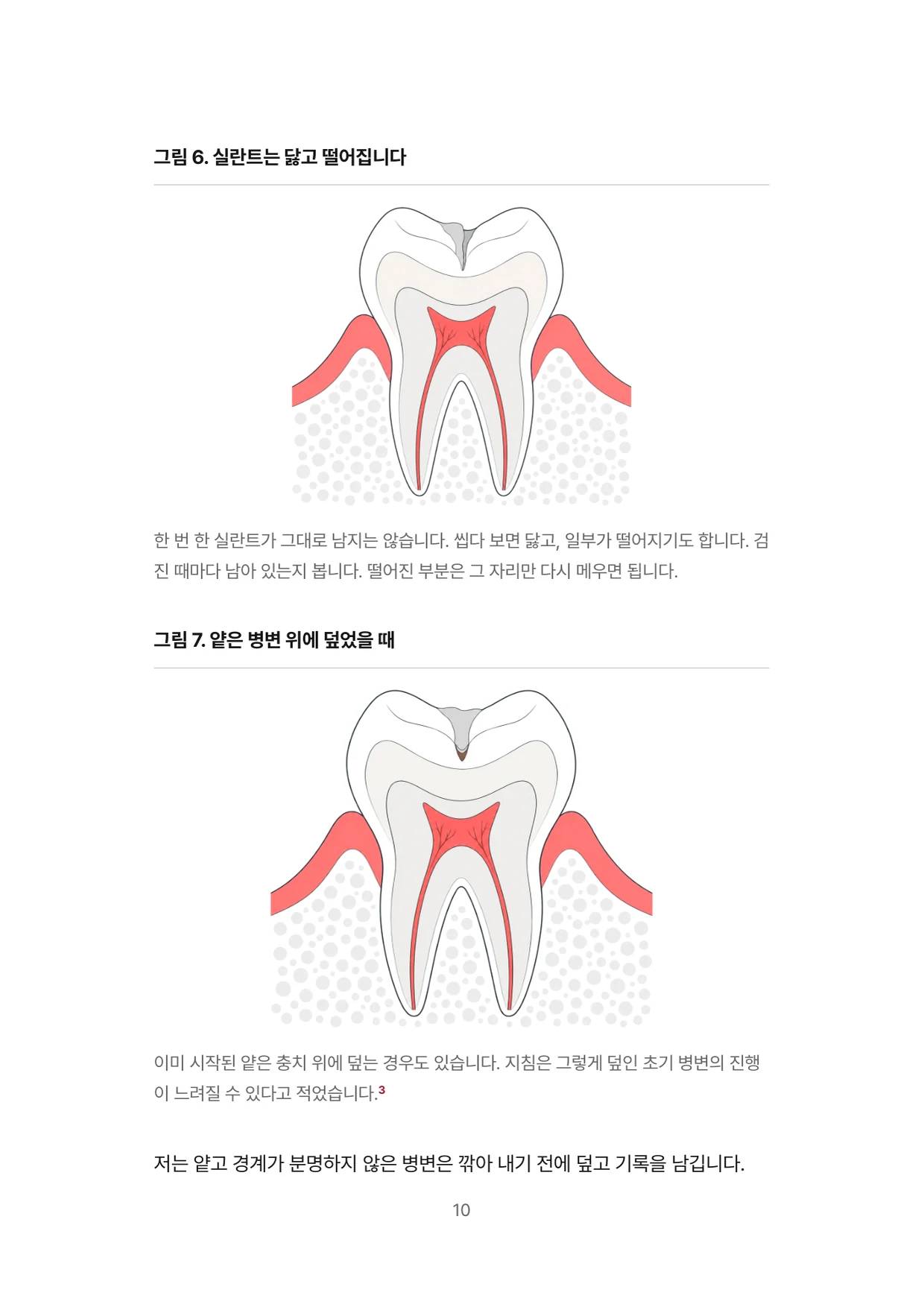 10면 실란트는 닳고 떨어집니다, 얕은 병변 위에 덮었을 때