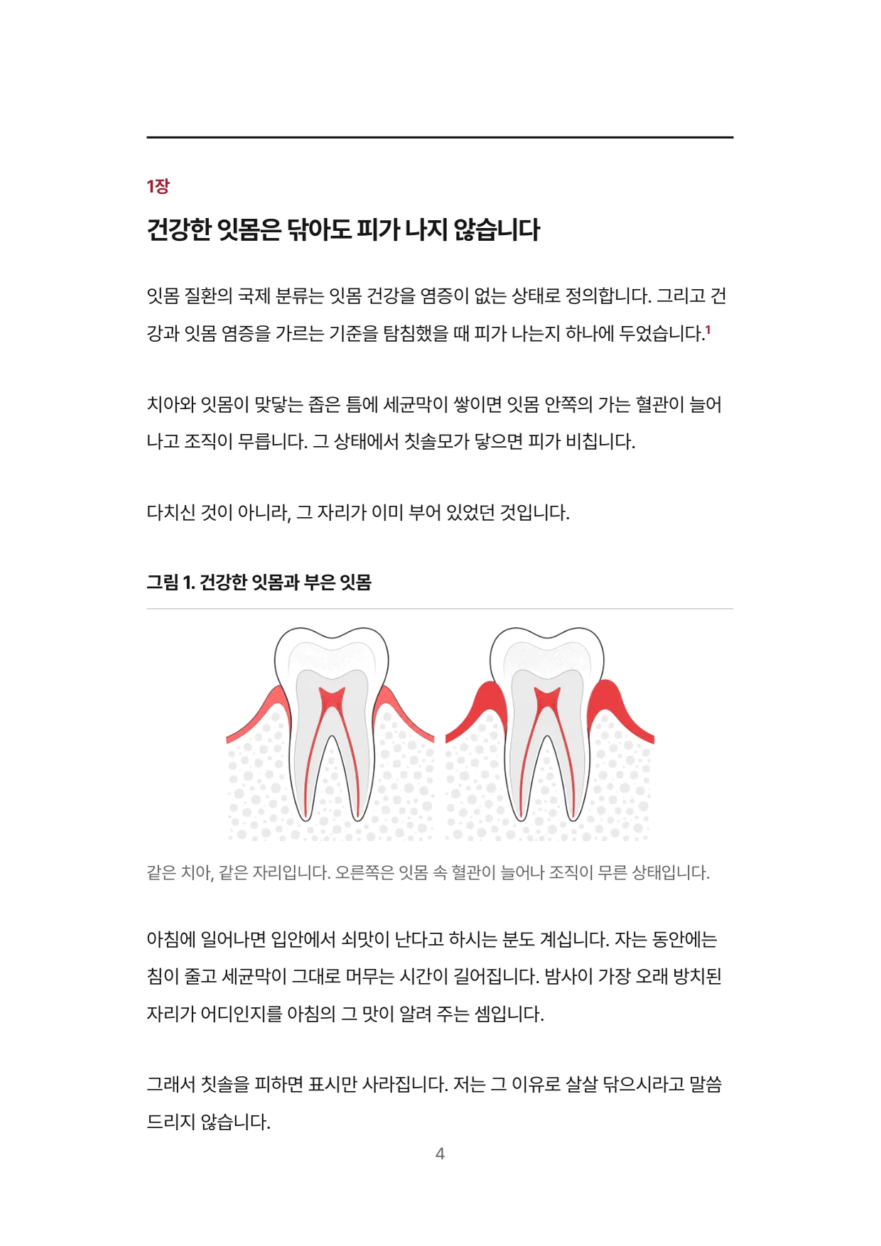 4면 1장 건강한 잇몸은 닦아도 피가 나지 않습니다, 건강한 잇몸과 부은 잇몸