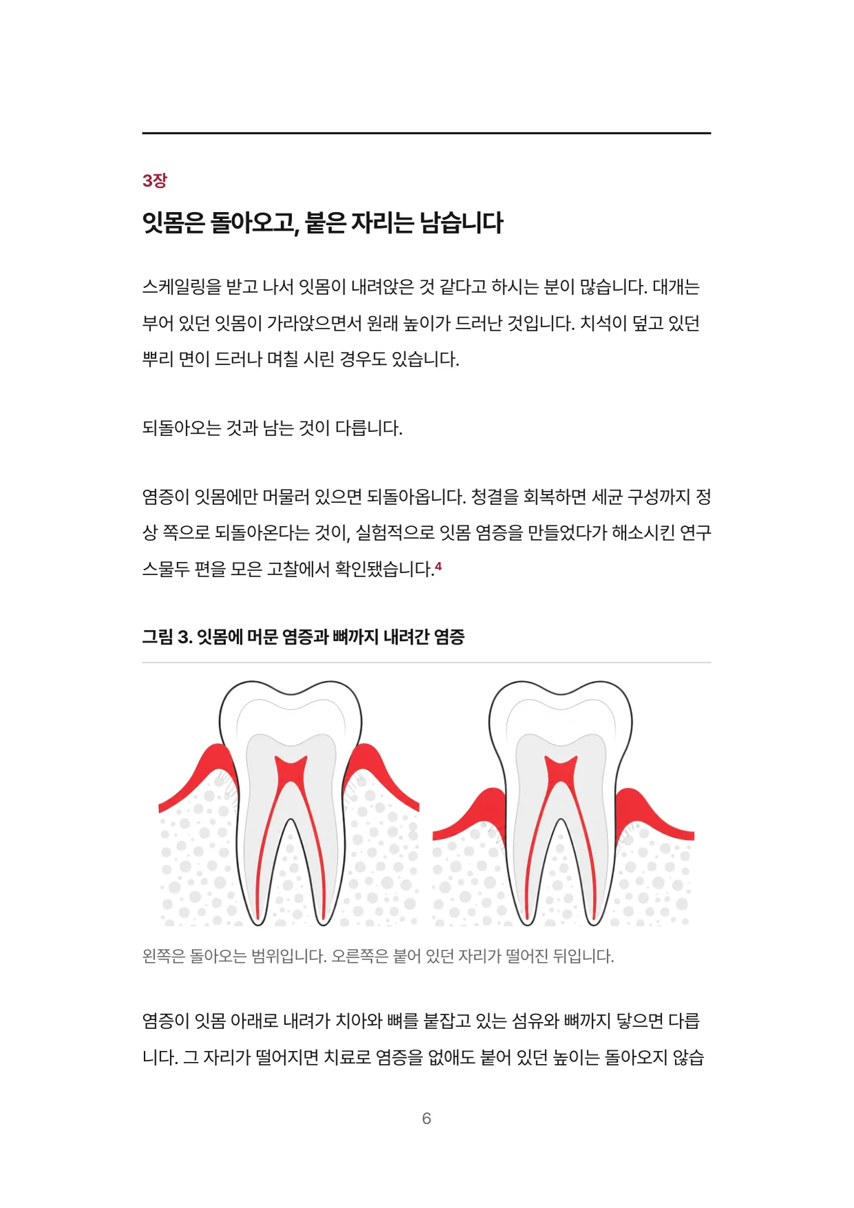 6면 3장 잇몸은 돌아오고 붙은 자리는 남습니다, 잇몸에 머문 염증과 뼈까지 내려간 염증